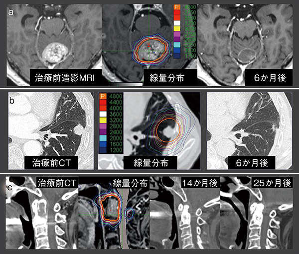 図5　サイバーナイフでの治療例 a：肺腺癌の転移性小脳腫瘍，40Gy/10分割 b：原発性肺がん（扁平上皮癌），48Gy/4分割 c：肺腺癌の転移性第2頸椎腫瘍，35Gy/5分割 aは有症状（嘔気・嘔吐）の転移例。照射後ほどなくして症状は改善している。bは無症状の原発性肺がん症例（左S8末梢）。照射後6か月で有害事象なく瘢痕化・腫瘍消失している。cは有痛性骨転移例。疼痛は速やかに改善し，14か月，25か月の時点では腫瘍の消失と骨化を認める。