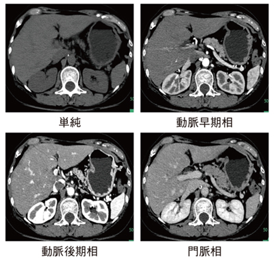 図2　造影剤を減量して造影CT検査を施行した症例