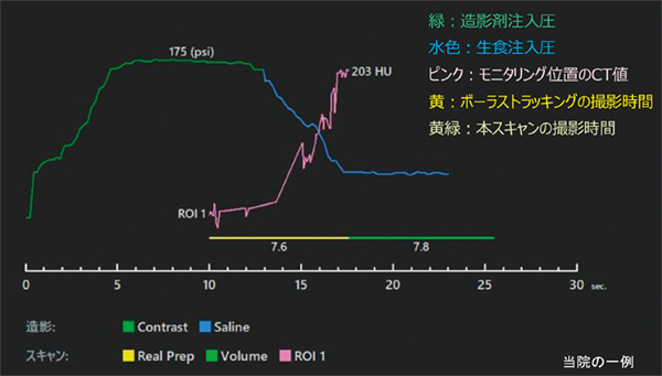 図7 冠動脈CT検査における造影剤注入結果 図7 冠動脈CT検査における造影剤注入結果