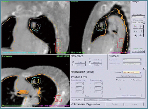 図5　Symmetryの1-click 4D-registration