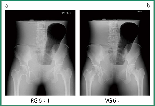 図1　腹部ファントムにおけるRG 6：1とVG 6：1の比較