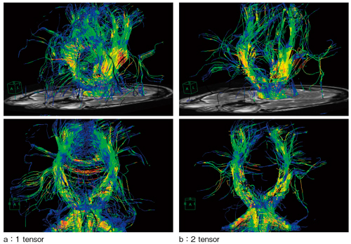 図3　ファイバートラッキング手法の違いによる拡散テンソル