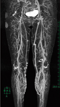 図8　非造影下肢MRV全長つなぎ合わせ画像