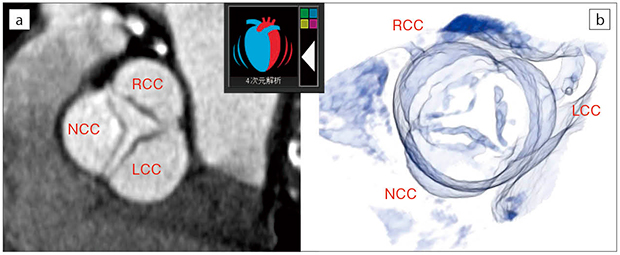 図1　症例1：“4次元解析”によるAoVの観察