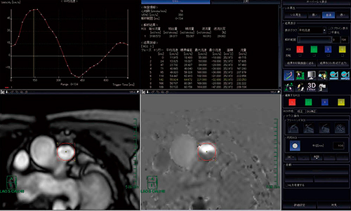図3　“MRフロー解析”による上行大動脈の血流量解析