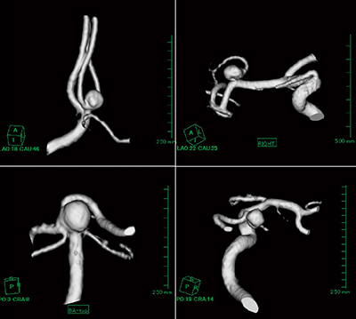 図1　MRA-VR画像（脳血管動脈瘤）