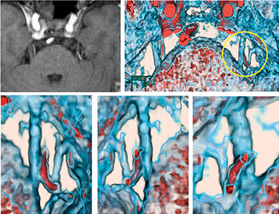 図2　三叉神経vascular compression image