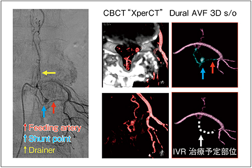 図6　診断アンギオから術前シミュレーションした3D画像