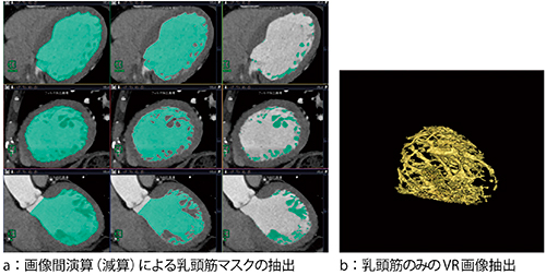 図3　マスク操作と画像間演算による乳頭筋抽出