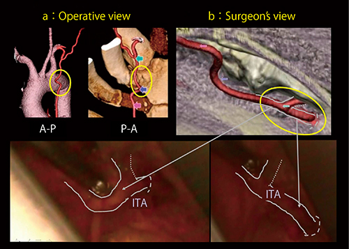 図4　LAD中枢側支援画像と術中画像