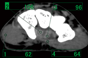 図3　135kVにおける屈筋腱と周囲組織のCT値