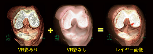 図5　前十字靭帯損傷例のレイヤー画像