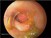図5　大腸内視鏡画像