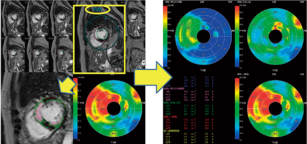 図4　遅延造影MRI