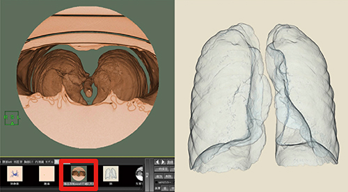 図4　肺の抽出 カラーマップ「肺抜き」で両肺を選択抽出，マスクを反転して，サイズ5で2回細く，3回太くする。