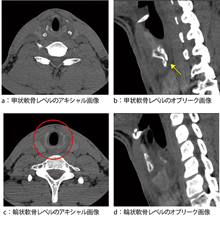 図1　喉頭部CT画像
