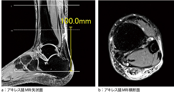 図2　計測データの位置決め 再現性を高めるため，アキレス腱の体積を計測する位置決めを行う。アキレス腱付着部から近位に10cmと決め，その範囲内にあるスライスからアキレス腱部のみを選択する。