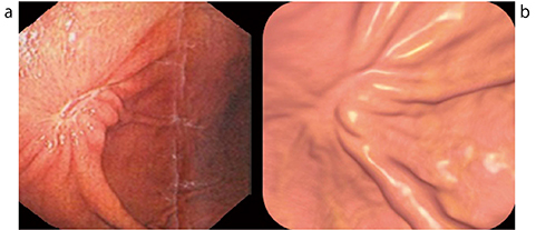 図6　症例2の内視鏡像（a）と仮想内視鏡像（b）