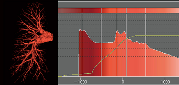 図5　肺動（静）脈カラーマップ オパシティカーブの傾きを緩やかにして，マイナス側CT値範囲を背景色と同系色とし，かつ裾野を広げる。