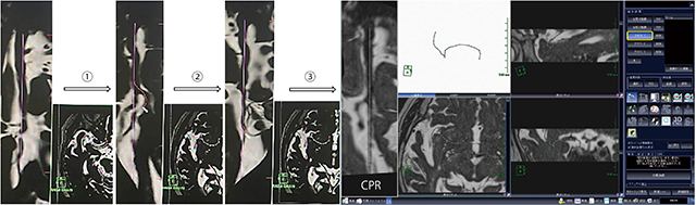 図3　血管分枝の画像化（1本目） AZE VirtualPlace雷神の心臓MR細血管解析を利用する手法であり，グラフト1を選択して右内頸動脈から右中大脳動脈方向に大まかに血管を選択する（(1)）。併走する中大脳動脈を間違って選択しても，CPR像を回転させながら血管の連続性を確認し，修正が可能である（(2)）。血管の中心を細かく補正し，できるだけ直線になるように血管を選択し（(3)），血栓がない中大脳動脈頭頂枝の走行が選択できている。