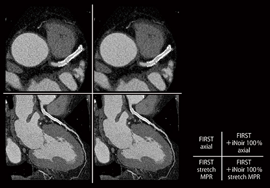 図5　症例1：coronary CTA（CCTA）