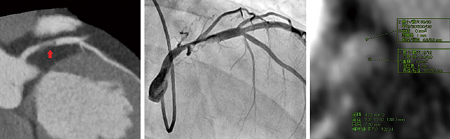図3　冠動脈解析ソフトウェアを用いた症例