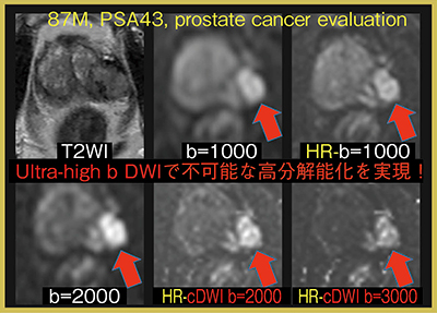 図4　ultra-high b の高分解能化