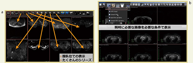 図1　乳腺MRIの読影