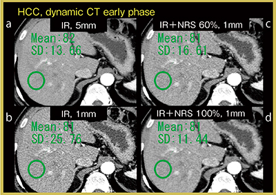 図3　肝細胞がん（61歳，男性）におけるSD比較