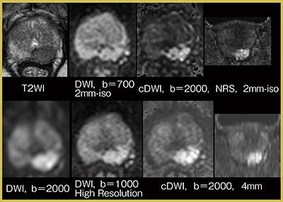 図5　cDWIにおけるultra high b値の高分解能化