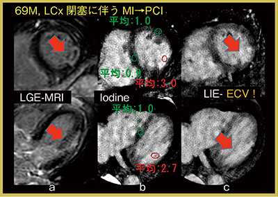 図6　心筋梗塞症例の遅延造影画像とECVマップ