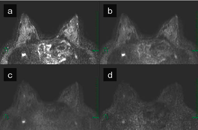 図2　Computed DWI あらゆるb値のDWIを計算できます。 a：b＝0，b：b＝500，c：b＝1000，d：b＝1500