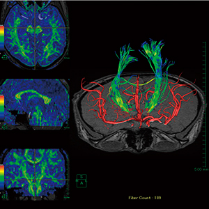 図4　拡散テンソル解析