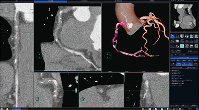 図2　冠動脈解析ソフトウェア“新CT細血管解析”によるCTOの表示