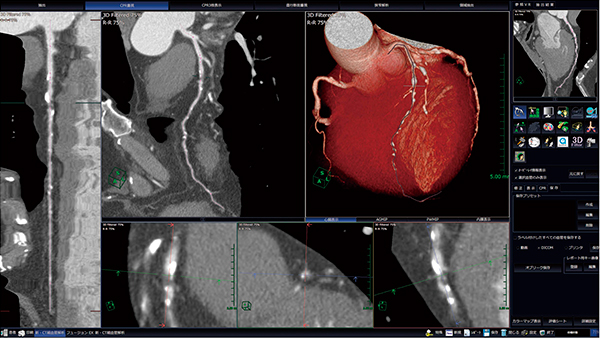 図1　冠動脈解析ソフトウェア