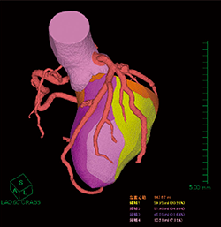 図4　心筋ボリュームメトリー画像