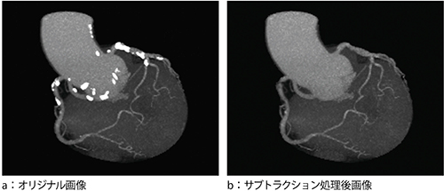 図5　VNCサブトラクション（angio graphic view）