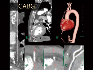 図1　冠動脈バイパスグラフト解析機能