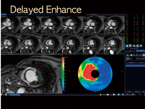 図3　遅延造影解析