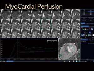 図4　MRI心筋パーフュージョン定量化ソフト