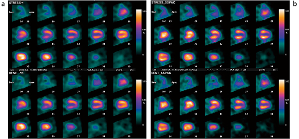 図1　201Tl  74MBqの低投与量による心筋シンチグラフィ