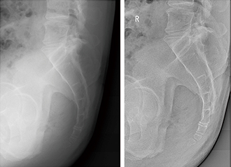 症例2　尾骨側面画像