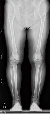 症例3　下肢全長撮影