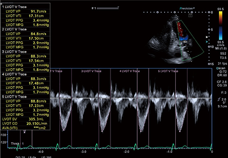 図1　Measurement AssistantによるLVOTの自動計測