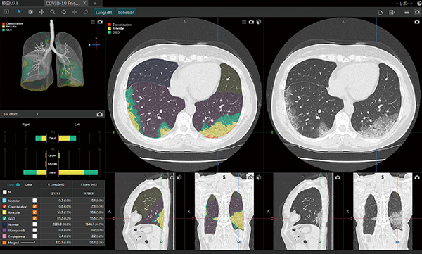 図1　藤田医科大学とキヤノンメディカルシステムズが共同研究により開発したCT texture解析を目的としたMachine Learningアルゴリズム COVID-19肺炎患者CTをCT texture解析を目的としたMachine Learningアルゴリズムで解析した場合、GGOは緑、Crazy-Paving Patternを含む網状影は黄色、浸潤影はオレンジと各CT textureに基づき表示できる。