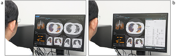 図3　「COVID-19肺炎解析ソフトウェア SCO-PA01（COVID-19 Analysis）」での読影風景 a：「COVID-19肺炎解析ソフトウェアSCO-PA01（COVID-19 Analysis）」による COVID-19 肺炎患者のCT読影時の自動画像解析結果表示例 b：同一患者のCT自動画像解析結果レポート記入例であり、解析結果は自動表示されるが、その他の所見に関しては読影結果をもとに読影者が入力し、読影レポートシステムに反映させる。