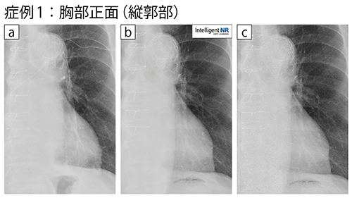 症例1：胸部正面（縦郭部）