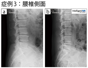 症例3：腰椎側面