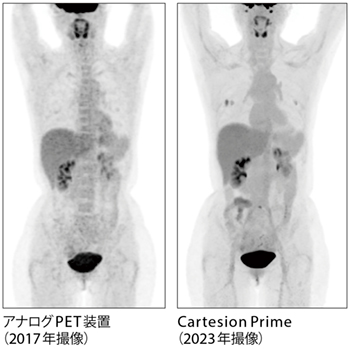 図1　右乳がん疑いの同一患者でのアナログPETとの画像比較