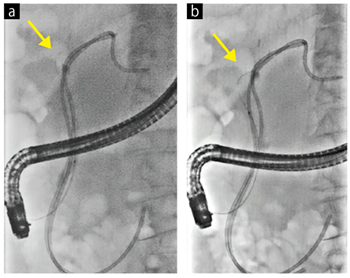 症例1　ガイドワイヤー「Radifocus 0.025inch」（テルモ製）の視認性が改善している。 a：通常の透視像　b：Accentの透視像